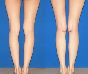 Коррекция формы ног: способы, методы и результаты