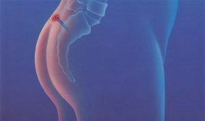 Что такое киста копчика и как ее лечить?